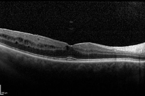 Macular Pucker 20/40 vision - minimal symptoms for 1 year Right eye
SD OCT line Scan Affected Eye
