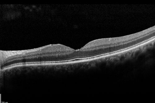 Macular Pucker 20/40 vision - minimal symptoms for 1 year Right eye
 SD OCT line Scan Fellow Eye 20/16 

