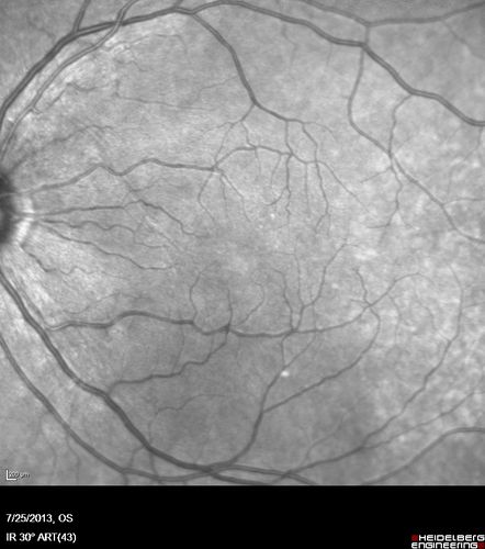 Macular Pucker 20/40 vision - minimal symptoms for 1 year Right eye
IR
