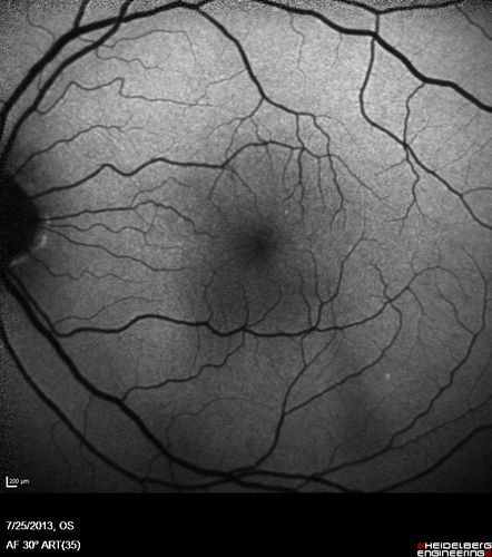 Macular Pucker 20/40 vision - minimal symptoms for 1 year Right eye
Fundus Autofluorescence

