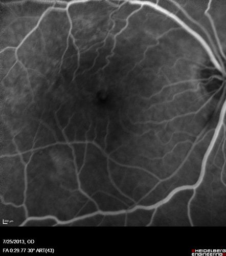 Macular Pucker 20/40 vision - minimal symptoms for 1 year Right eye
FA shows leakage from traction from pucker in the right eye - cystoid macular edema
