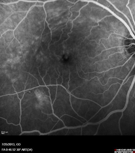 Macular Pucker 20/40 vision - minimal symptoms for 1 year Right eye
FA shows leakage from traction from pucker in the right eye - cystoid macular edema
