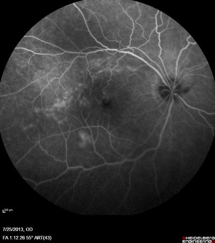 Macular Pucker 20/40 vision - minimal symptoms for 1 year Right eye
FA shows leakage from traction from pucker in the right eye - cystoid macular edema
