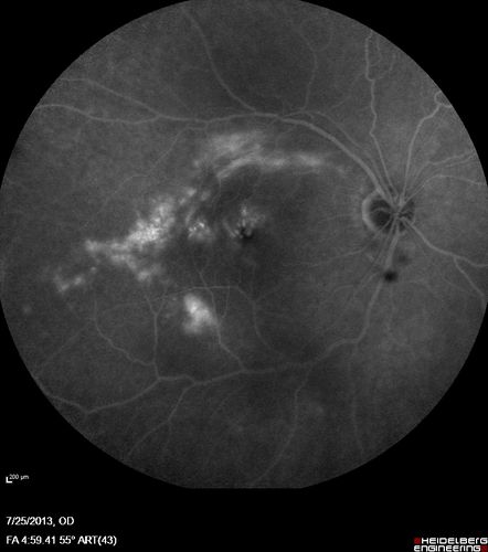 Macular Pucker 20/40 vision - minimal symptoms for 1 year Right eye
FA shows leakage from traction from pucker in the right eye - cystoid macular edema
