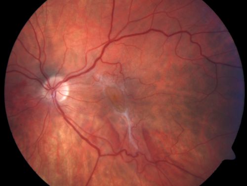 Post Retinal Detachment Repair Macular Pucker - VA 20/400 Pre-op 20/25 Post-op
72 year old woman who is 6 months post macula-on retinal detachment repair developed a 20/400 macular pucker.  8 months after surgery vision had improved to 20/25
