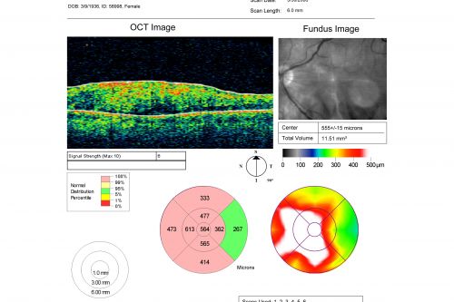 Post Retinal Detachment Repair Macular Pucker - VA 20/400 Pre-op 20/25 Post-op
72 year old woman who is 6 months post macula-on retinal detachment repair developed a 20/400 macular pucker.  8 months after surgery vision had improved to 20/25
