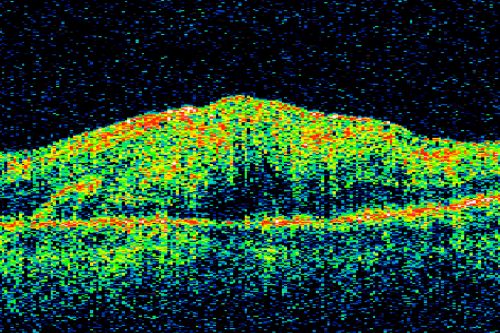 Post Retinal Detachment Repair Macular Pucker - VA 20/400 Pre-op 20/25 Post-op
72 year old woman who is 6 months post macula-on retinal detachment repair developed a 20/400 macular pucker.  8 months after surgery vision had improved to 20/25
