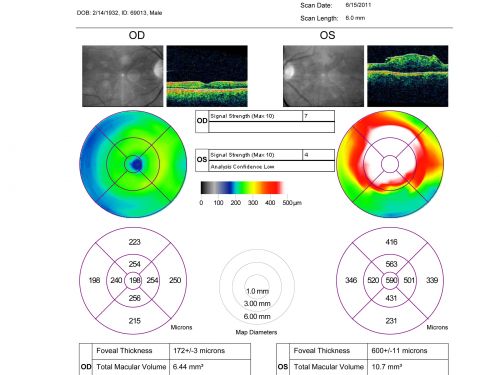 Asymptomatic 20/200 Macular Pucker 79 year old man - Left Eye
79-year-old man who had not noticed a change in vision, but was diagnosed with a macular pucker in the left eye.  Even now he doesnâ€™t notice much difference between the eyes, although he doesnâ€™t usually compare them.  He has a prescription for new glasses.  

VISUAL ACUITY:  OD 20/80,  Pinhole 20/50.  OS 20/200.

