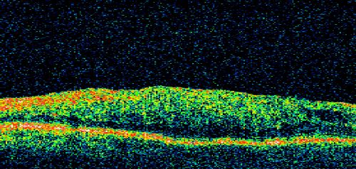 Asymptomatic 20/200 Macular Pucker 79 year old man - Left Eye
79-year-old man who had not noticed a change in vision, but was diagnosed with a macular pucker in the left eye.  Even now he doesnâ€™t notice much difference between the eyes, although he doesnâ€™t usually compare them.  He has a prescription for new glasses.  

VISUAL ACUITY:  OD 20/80,  Pinhole 20/50.  OS 20/200.

