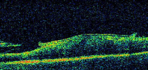 Asymptomatic 20/200 Macular Pucker 79 year old man - Left Eye
79-year-old man who had not noticed a change in vision, but was diagnosed with a macular pucker in the left eye.  Even now he doesnâ€™t notice much difference between the eyes, although he doesnâ€™t usually compare them.  He has a prescription for new glasses.  

VISUAL ACUITY:  OD 20/80,  Pinhole 20/50.  OS 20/200.

