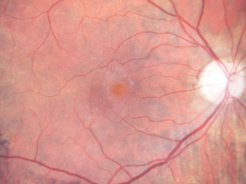 Macular Pucker 20/40 Vision 
59-year-old woman blurry vision in the right eye for about the last one or two years.  She had cataract surgery in 1981, a retinal detachment repair with scleral buckle in 1988 in the right eye, and then she had lens implants in both eyes, anterior chamber lenses, in 1994.   She did start taking Latisse for eyelashes about a year and a half ago.

VISUAL ACUITY:  Vision OD is 20/40, OS is 20/20
(4 months later with a short course of antiinflammatory drops and new glasses her vision improved to 20/25)
