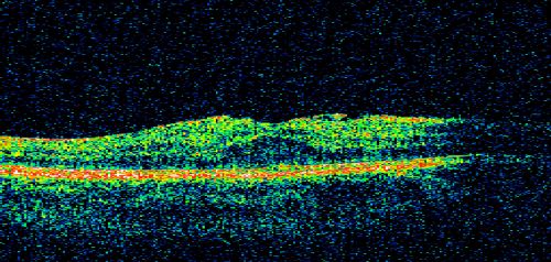 Macular Pucker 20/40 Vision 
59-year-old woman blurry vision in the right eye for about the last one or two years.  She had cataract surgery in 1981, a retinal detachment repair with scleral buckle in 1988 in the right eye, and then she had lens implants in both eyes, anterior chamber lenses, in 1994.   She did start taking Latisse for eyelashes about a year and a half ago.

VISUAL ACUITY:  Vision OD is 20/40, OS is 20/20
(4 months later with a short course of antiinflammatory drops and new glasses her vision improved to 20/25)

