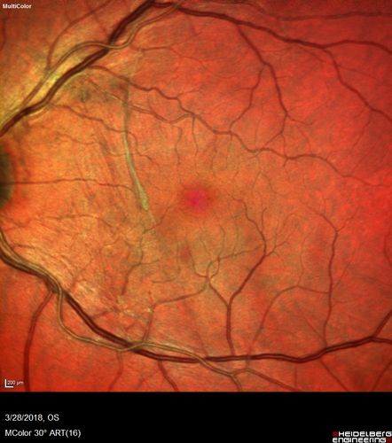 Spontaneously Peeled Macular Pucker 20/20 Vision
