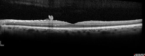Spontaneously Peeled Macular Pucker 20/20 Vision

