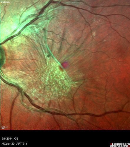 Macular Pucker 20/32 with increased distortion for a month
