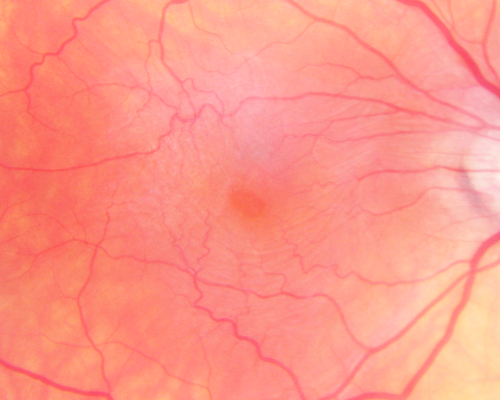 Macular Pucker Pre-op 20/200 vision (history of retinal tears)
66-year-old man has had laser to retinal tears in both eyes in 1999 and in 2001.   His right eye has had rapidly declining vision over the last month.  VISUAL ACUITY:     OD:  20/200

