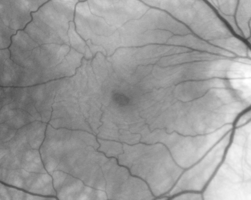 Macular Pucker Pre-op 20/200 vision (history of retinal tears)
66-year-old man has had laser to retinal tears in both eyes in 1999 and in 2001.   His right eye has had rapidly declining vision over the last month.  VISUAL ACUITY:     OD:  20/200
