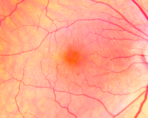 Macular Pucker Post-op 20/30 Vision
Va 20/30 after surgery
