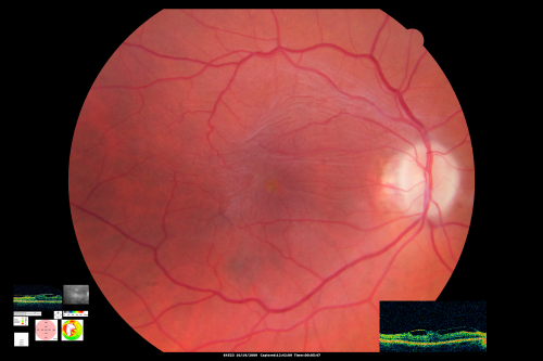 Macular Pucker
Fundus photo with OCT superimposed, 20/100 macular pucker
Schlüsselwörter: macular pucker