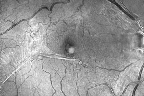 Macular Pucker - Spontaneously Partial Peel after 20 Years.  Vision improved to 20/30
83-year-old woman decreased vision in the right eye for about a month.  20 years ago she was diagnosed with a macular pucker OD 20/50,  OS 20/20.
