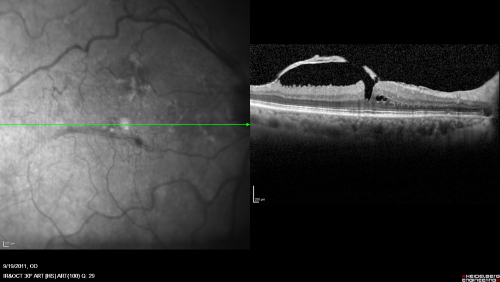 Macular Pucker - Spontaneously Partial Peel after 20 Years.  Vision improved to 20/30
83-year-old woman decreased vision in the right eye for about a month.  20 years ago she was diagnosed with a macular pucker OD 20/50,  OS 20/20.
