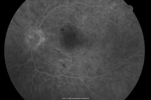 Purtchers Retinopathy with Bilateral Central Retinal Artery Occlusions 
50-year-old man traumatic chest compression and leg crushing injury. OD 1/200, OS 3/200
Keywords: purtcher;purtchers;crao;hemorrhage