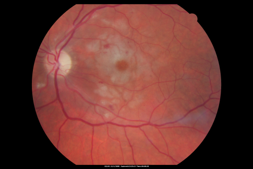 Purtchers Retinopathy with Bilateral Central Retinal Artery Occlusions 
50-year-old man traumatic chest compression and leg crushing injury. OD 1/200, OS 3/200
Keywords: purtcher;purtchers;crao;hemorrhage