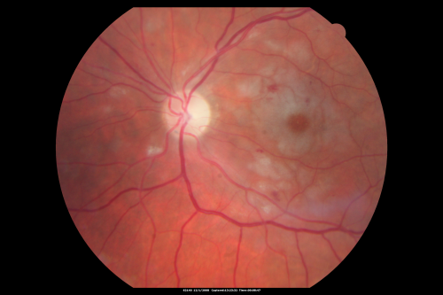Purtchers Retinopathy with Bilateral Central Retinal Artery Occlusions 
50-year-old man traumatic chest compression and leg crushing injury. OD 1/200, OS 3/200
Keywords: purtcher;purtchers;crao;hemorrhage