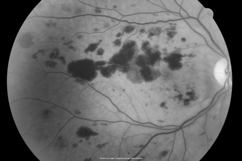 Purtchers Retinopathy with Bilateral Central Retinal Artery Occlusions 
50-year-old man traumatic chest compression and leg crushing injury. OD 1/200, OS 3/200
Keywords: purtcher;purtchers;crao;hemorrhage