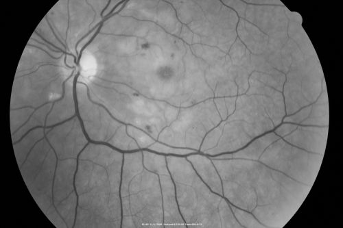 Purtchers Retinopathy with Bilateral Central Retinal Artery Occlusions 
50-year-old man traumatic chest compression and leg crushing injury. OD 1/200, OS 3/200
Keywords: purtcher;purtchers;crao;hemorrhage