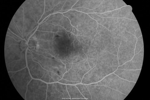 Purtchers Retinopathy with Bilateral Central Retinal Artery Occlusions 
50-year-old man traumatic chest compression and leg crushing injury. OD 1/200, OS 3/200
Võtmesõnad: purtcher;purtchers;crao;hemorrhage