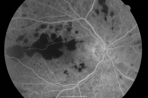 Purtchers Retinopathy with Bilateral Central Retinal Artery Occlusions 
50-year-old man traumatic chest compression and leg crushing injury. OD 1/200, OS 3/200
Võtmesõnad: purtcher;purtchers;crao;hemorrhage