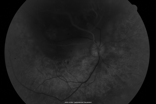 radiationretinopathy_brda06.png