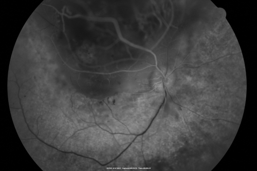 radiationretinopathy_brda07.png