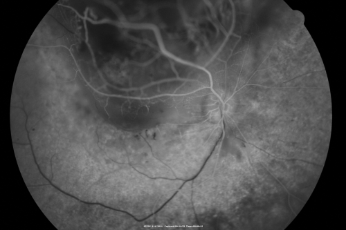 radiationretinopathy_brda08.png