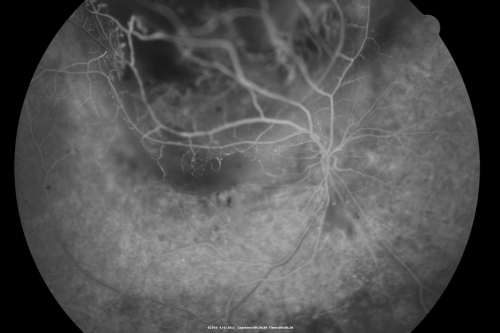 radiationretinopathy_brda10.png