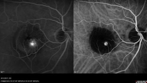 Retinal Angiomatous Proliferation - Type III choroidal neovascular membrane
83 year old female with wet AMD - 20/160 VA- Vision improved to 20/40 with 3 injections of anti-VEGF drugs.  OCT shows break in RPE and FA and ICG show PED with hot spot on ICG
