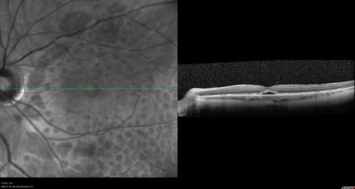 Persistent Subfoveal Fluid Following Retinal Detachment Repair
Patient had pneumatic retinopexy for macula off RD and subfoveal fluid persisted for 12 months but was gone at 18 months.  IR images show pockets of fluid after the first week.

