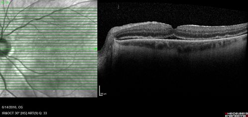 Persistent Subfoveal Fluid Following Retinal Detachment Repair
Patient had pneumatic retinopexy for macula off RD and subfoveal fluid persisted for 12 months but was gone at 18 months.  IR images show pockets of fluid after the first week.
