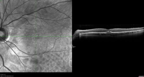 Persistent Subfoveal Fluid Following Retinal Detachment Repair
Patient had pneumatic retinopexy for macula off RD and subfoveal fluid persisted for 12 months but was gone at 18 months.  IR images show pockets of fluid after the first week.
