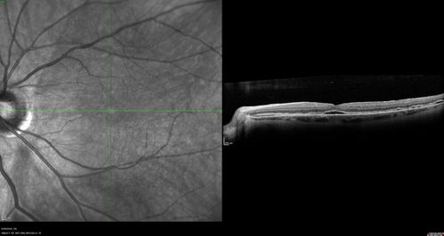 Persistent Subfoveal Fluid Following Retinal Detachment Repair
Patient had pneumatic retinopexy for macula off RD and subfoveal fluid persisted for 12 months but was gone at 18 months.  IR images show pockets of fluid after the first week.

