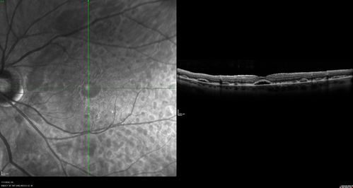 Persistent Subfoveal Fluid Following Retinal Detachment Repair
Patient had pneumatic retinopexy for macula off RD and subfoveal fluid persisted for 12 months but was gone at 18 months.  IR images show pockets of fluid after the first week.
