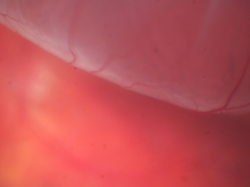 Superior Retinal Detachment - Bullous - Macula-off
70-year-old man  noticed a shadow creeping over the vision in the left eye and he no longer sees well out of that eye.  He had cataract surgery two years ago and a YAG capsulotomy six months ago.  

VISUAL ACUITY:  OD 20/20,  OS 1/200
