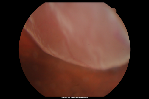 Pseudophakic Macula-Off Retinal Detachment with Larger Retinal Tear
68-year-old woman with veil over her vision just the last few days.  She had cataract surgery a year ago.  OD 20/200 -- One year later vision 20/30!
Palabras clave: retinal detachment;gas;tear