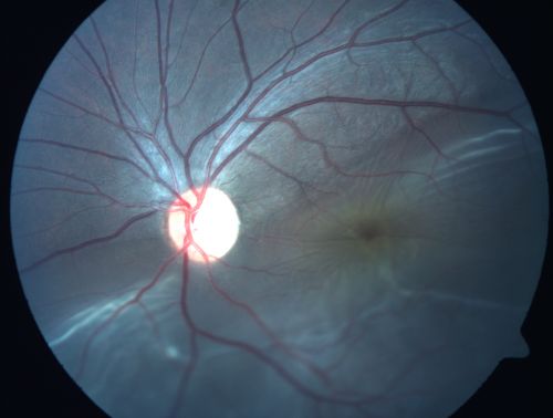 Retinal Detachment with Subretinal Fibrosis - Chronic with new Foveal Involvement 25 Year Old
25-year-old man vision loss in the left eye for a month.  He noticed a shadow up above, which went through his central vision.  He has not had any injuries in the left eye.  
VISUAL ACUITY:  Vision OD is 20/20, OS is 20/400
