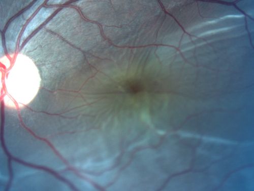 Retinal Detachment with Subretinal Fibrosis - Chronic with new Foveal Involvement 25 Year Old
25-year-old man vision loss in the left eye for a month.  He noticed a shadow up above, which went through his central vision.  He has not had any injuries in the left eye.  
VISUAL ACUITY:  Vision OD is 20/20, OS is 20/400
