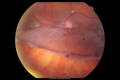 Retinal Detachment Under Oil with Inferior Retinectomy
Vision 2/200 surgery 1 month ago.
