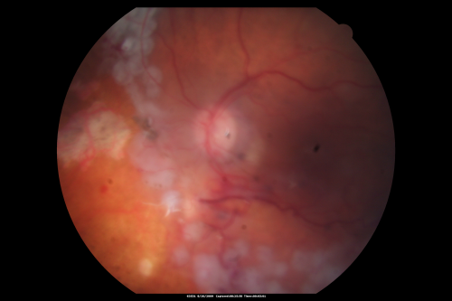 Retina Attached Under Oil after oil exchange, perfluoron, laser
Final visual acuity was 2/200 with hypotony and band keratopathy
