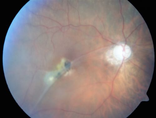 Macular Fold - 40 years post retinal detachment repair - Glaucoma 
79-year-old woman has had a long-standing macular fold in the right eye associated with retinal detachment repair in 1970. (40 years ago) She has a macular scar in that eye.  She has optic atrophy in both eyes from glaucoma.   Vision OD is hand motion, OS is 20/50
