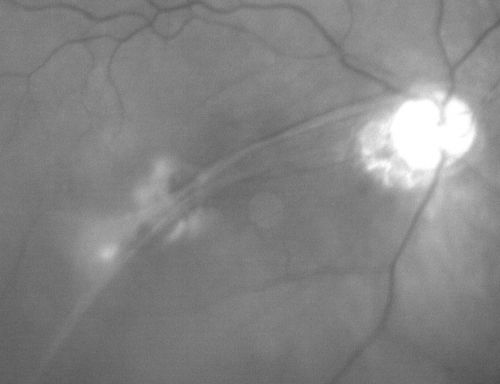 Macular Fold - 40 years post retinal detachment repair - Glaucoma 
79-year-old woman has had a long-standing macular fold in the right eye associated with retinal detachment repair in 1970. (40 years ago) She has a macular scar in that eye.  She has optic atrophy in both eyes from glaucoma.   Vision OD is hand motion, OS is 20/50
